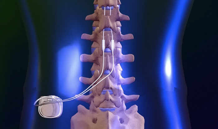 When Spinal Cord Stimulators are not helping – Caring Medical Florida