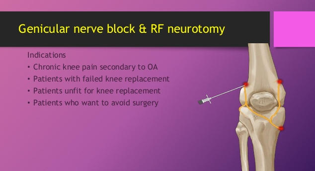 How to Bill CPT Code for Genicular Nerve Block RFA