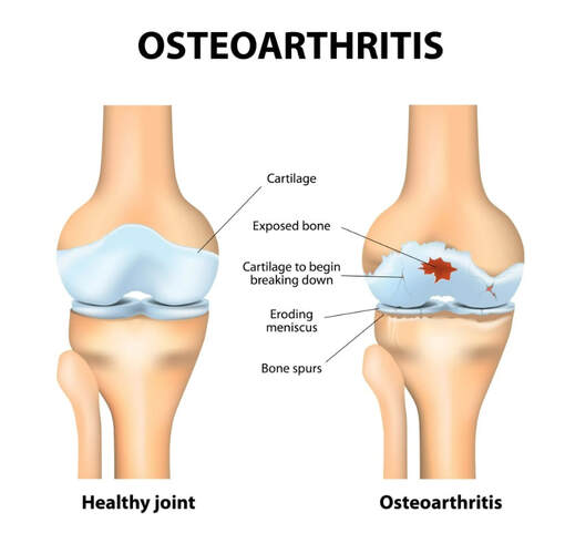 PRIOR AUTHORIZATION, PRECERTIFICATION & BILLING PROCESS FOR HYALURONAN ACID & VISCO THERAPIES FOR OSTEOARTHRITIS OF THE KNEE